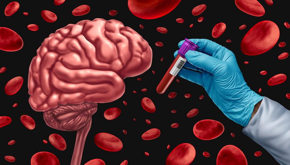 Bluttests sollen Alzheimer frühzeitig, einfach und kostengünstig nachweisen können. Bild: Wildpixel / Getty