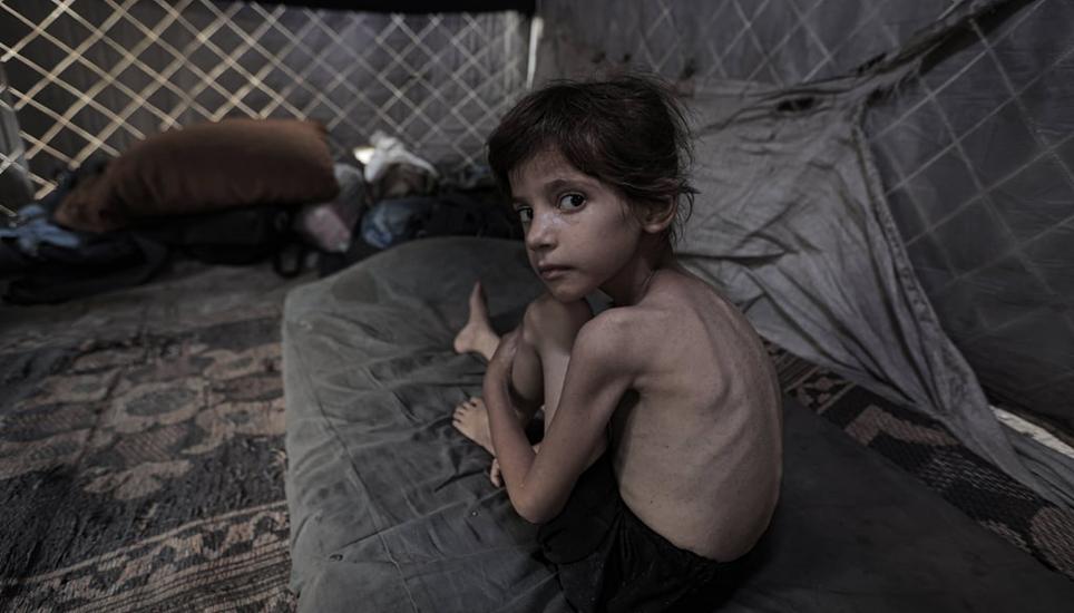 Die fünfjährige Lana Salih Juha, die mit ihrer Familie aus dem Viertel Schudschaiyya ins Stadtzentrum geflüchtet ist, leidet unter schwerer Mangelernährung. Mohammed Y. M. Al-Yaqoubi / Imago / Anadolu Gaza-Stadt