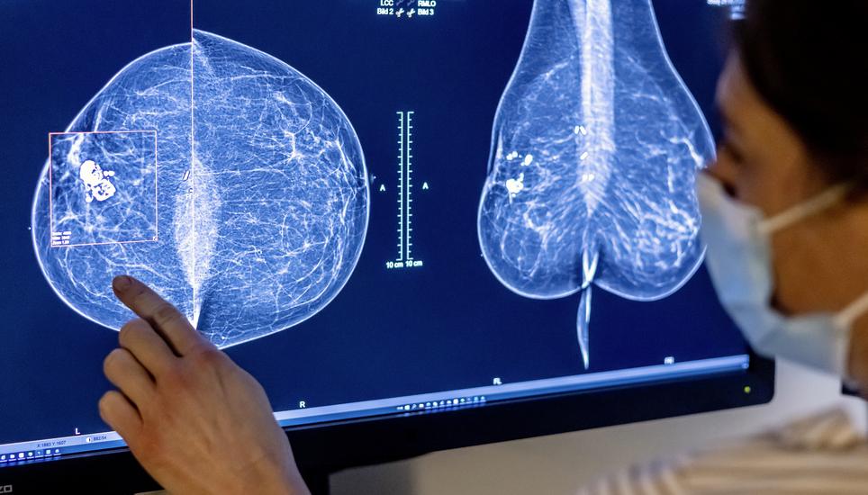 Mammografien helfen bei der Früherkennung von Brustkrebs. Bild: Keystone